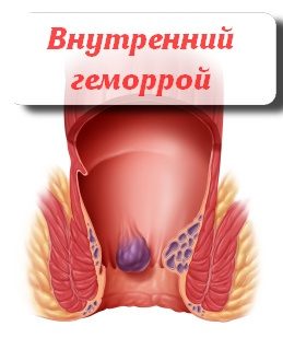 внутренний геморрой